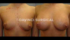 breast-augmentation-03