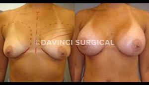 breast-augmentation-05