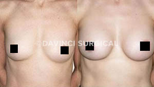 breast-augmentation-06