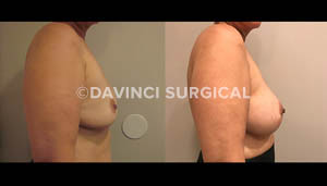 breast-augmentation-13
