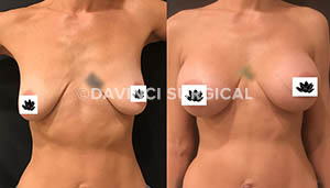breast-augmentation-15