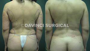 liposuction-02