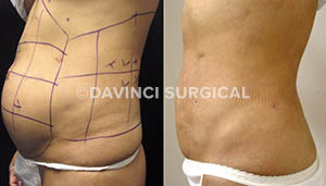 liposuction-10